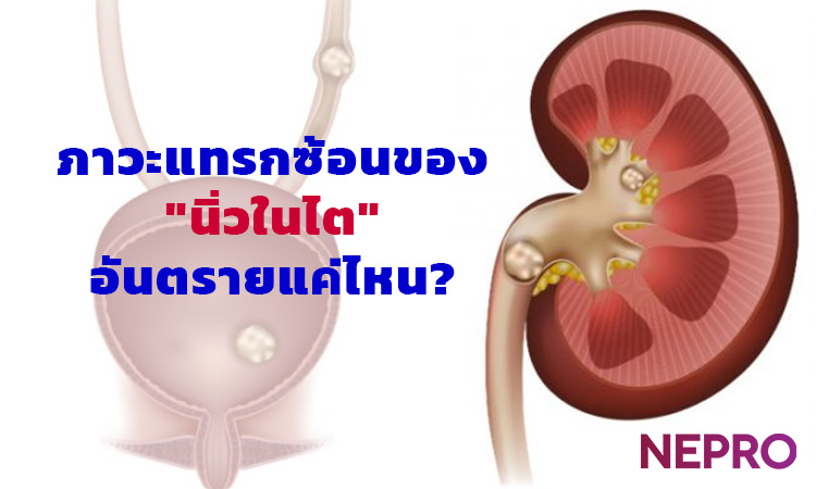 ภาวะแทรกซ้อนจากนิ่วในไตอันตรายแค่ไหน?