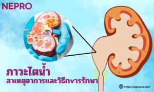 ภาวะไตน้ํา - สาเหตุอาการและวิธีการรักษา